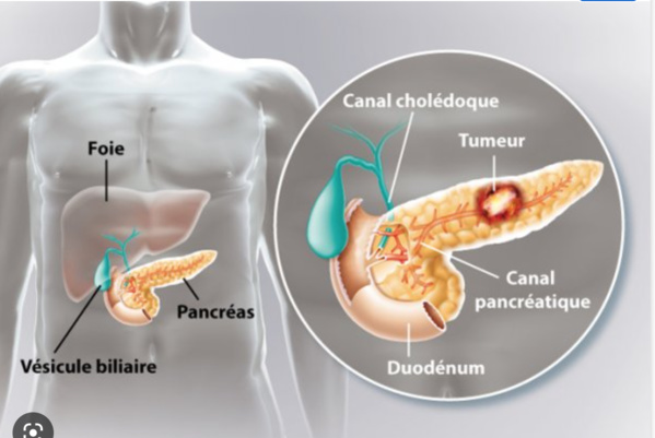 Hôpital militaire : extraction réussie d’une tumeur au pancréas d’une personne âgée (détails)