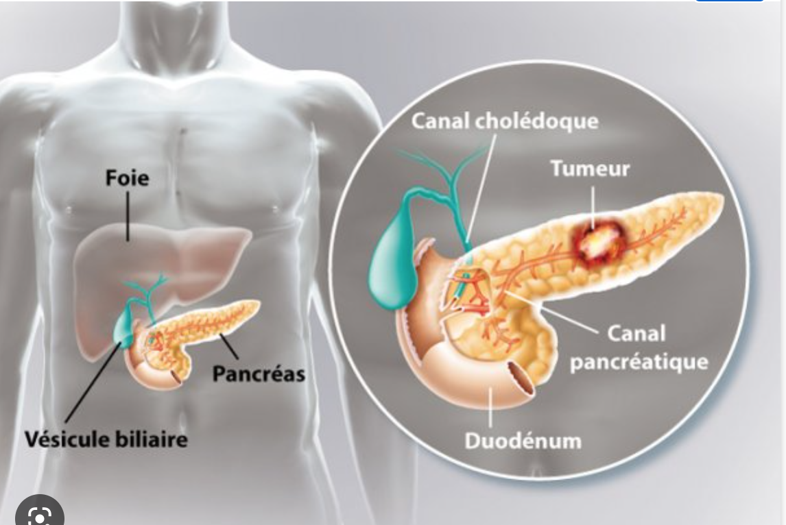 Hôpital militaire : extraction réussie d’une tumeur au pancréas d’une personne âgée (détails)